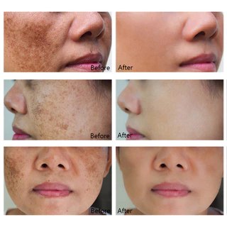 เซรั่มลดฝ้า กระ จุดด่างดํา เซรั่มลดฝ้า เซรั่มฝ้า 100ml กำจัดฝ้า จุดด่างดำ กระ ฝ้า ลบเมลานิน กระจ่างใสผิว แก้ฝ้าทุกชนิด