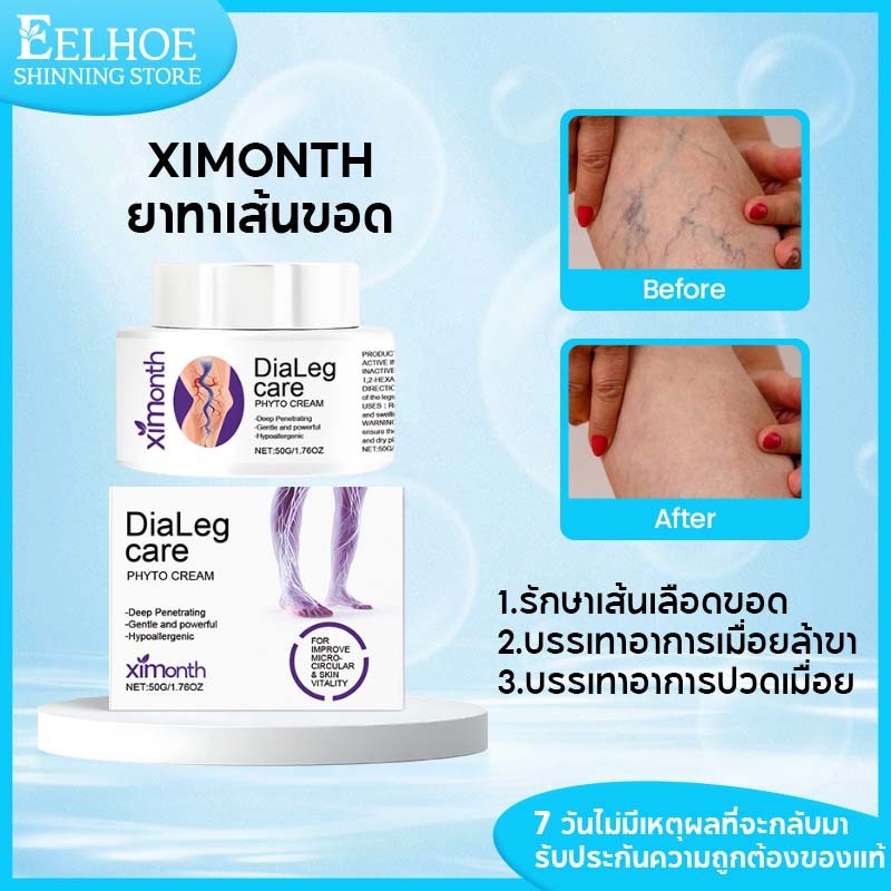 Ximonth รักษาเส้นเลือดขอด สูตรอ่อนโยน แก้ปวดเมื่อย บรรเทาอาการไม่สบาย บำรุงผิวกาย บำรุงผิวเฉพาะจุด