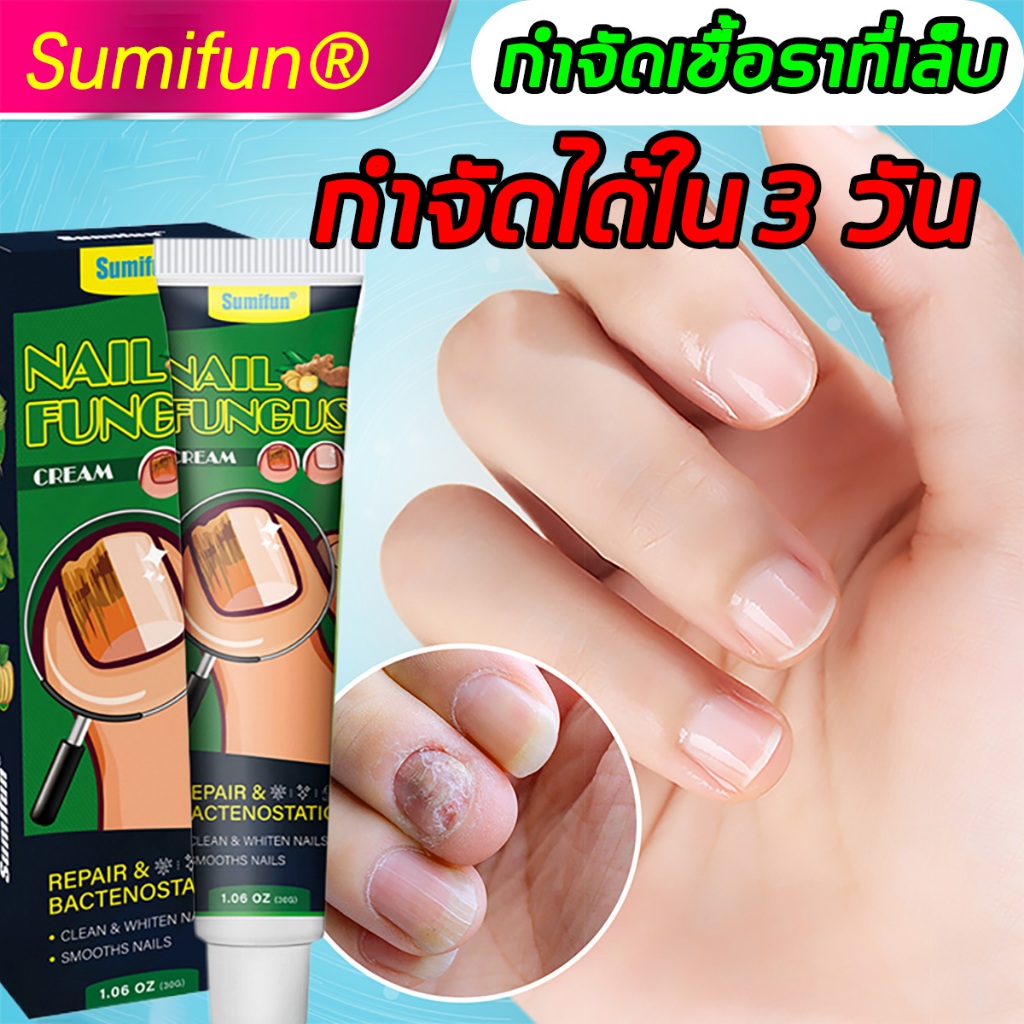🔥7วัน ซ่อมแซมเล็บเสียอย่างรวดเร็ว🔥 ซ่อมแซมเล็บ เชื้อราเล็บมือ แก้เชื้อราที่เล็บ บำรุงเล็บ ลากับเล็บเสีย