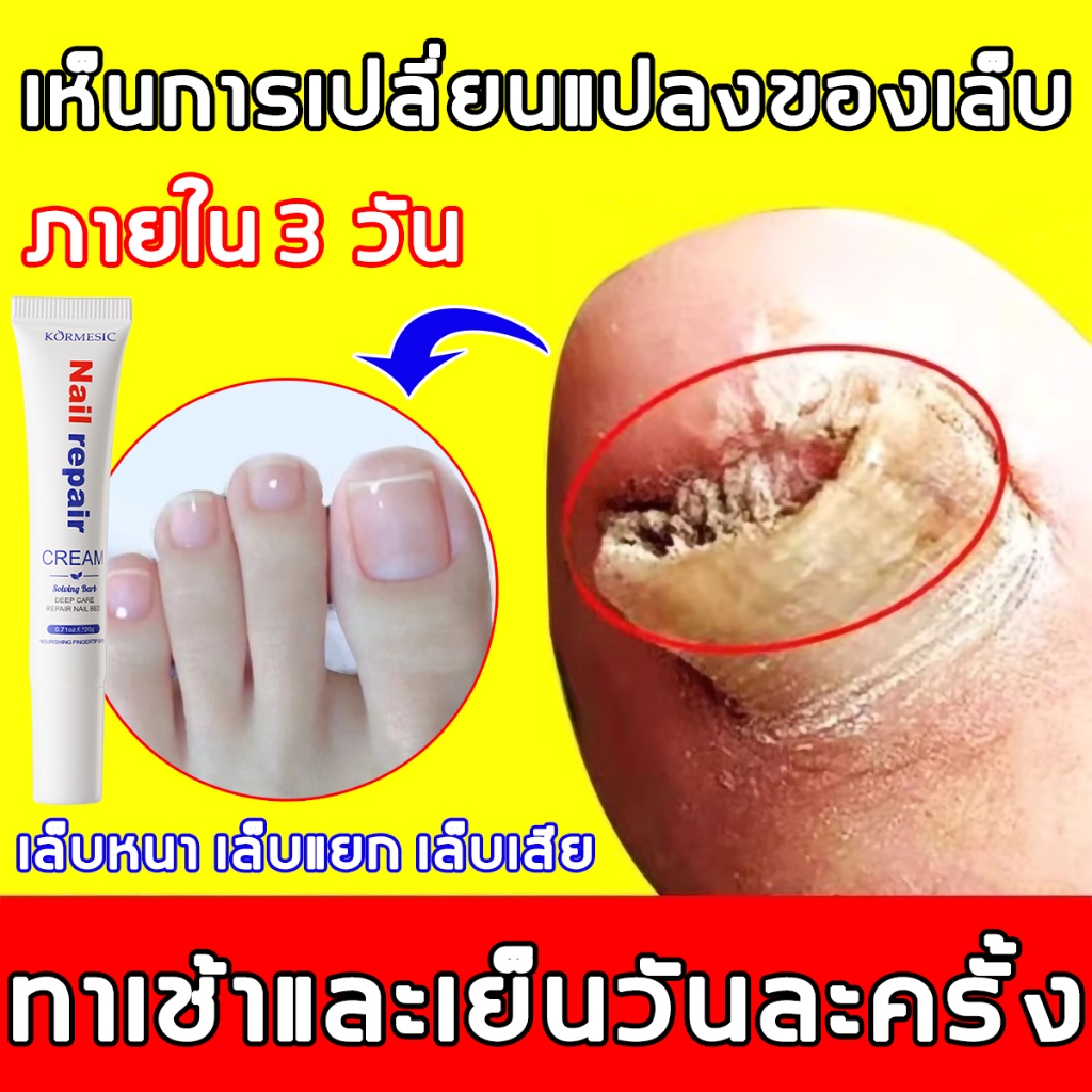 ทาเช้า-เย็น เซรั่มบำรุงเล็บ 20g ยาทาเชื้อราเล็บ บำรุงเล็บ ซ่อมแซมเล็บ เล็บแข็งแรง ห่างปัญหาเล็บ
