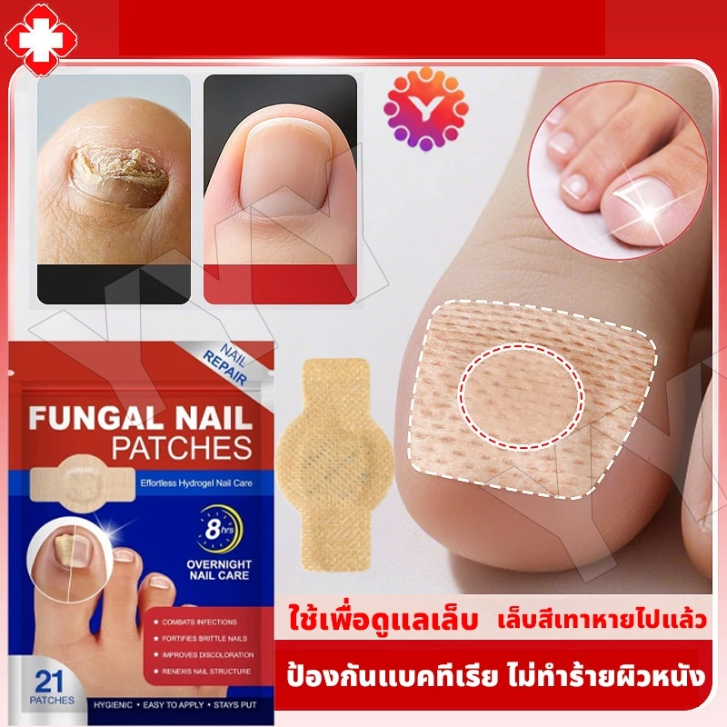 แผ่นแปะดูแลเล็บ แผ่นแปะเล็บเชื้อรา แพทช์แก้ไขเล็บเท้าคุด แอนตี้เชื้อรา แก้ไขเล็บขบ ดูแลเล็บเท้าติดเชื้อ