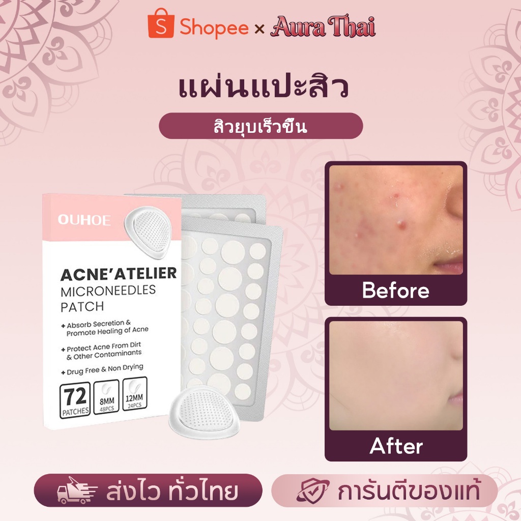 OUHOE แผ่นแปะสิวหัวเข็ม72 แผ่นแปะสิวไมโครดอท แผ่นแปะสิวไฮโดรคอลลอยด์ กันน้ำและมองไม่เห็น ช่วยลดอาการอักเสบให้สิวยุบไว