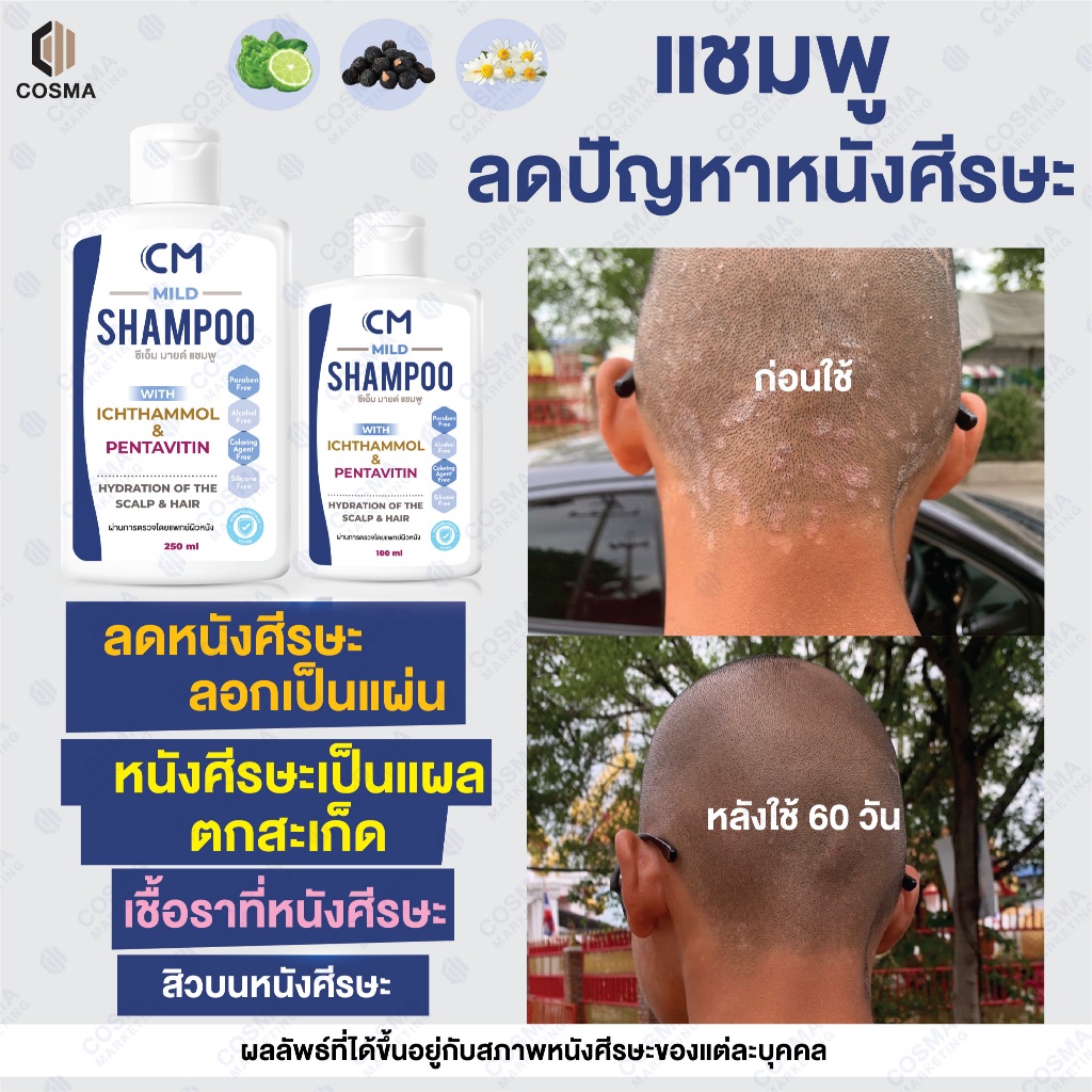 แชมพูลดปัญหาหนังศีรษะลอก แห้ง คัน CM Mild Shampoo ผมไม่แห้งกระด้าง ดีกว่า TAR(ทาร์)