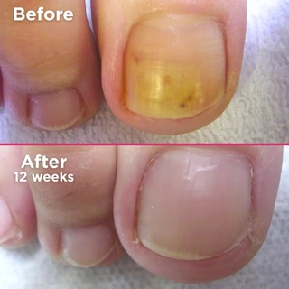 Footlogix #7T สเปรย์รักษาเชื้อราเล็บ ฆ่าเชื้อรา เล็บมือ เล็บเท้า ของแท้ นำเข้าแคนาดา 50ml
