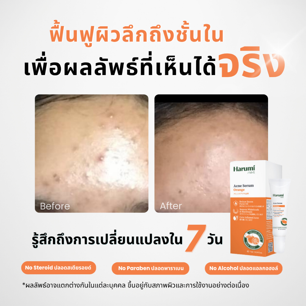 HARUMI yuzu acne serum สิว รอยสิว สิวเสี้ยน