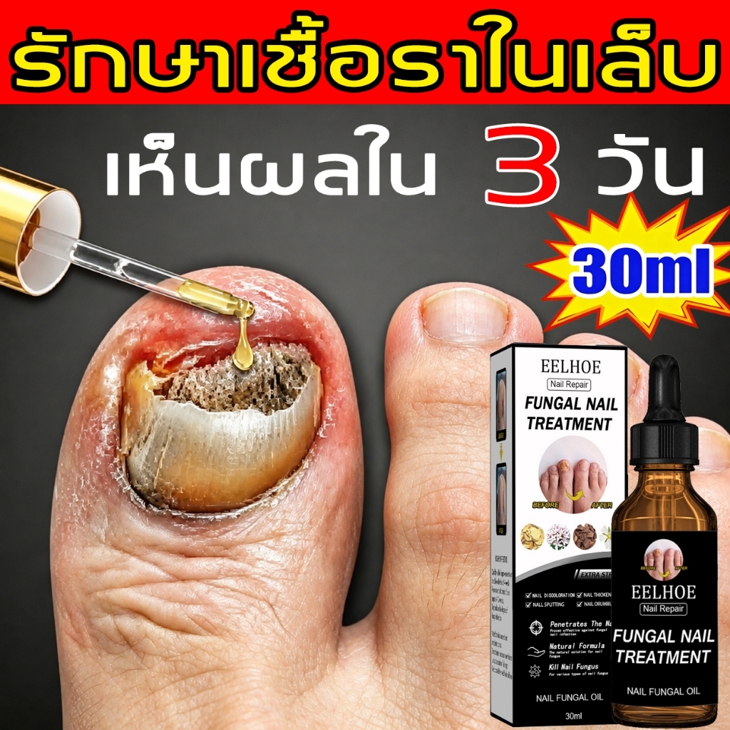 👍เห็นผลรวดเร็ว👍น้ำยารักษาเล็บ เชื้อราเล็บ กำจัดเชื้อราเล็บ สูตรพืชธรรมชาติ ให้ขาวเงา บำรุงมือและเท้า ใช้งานง่าย 30 มล