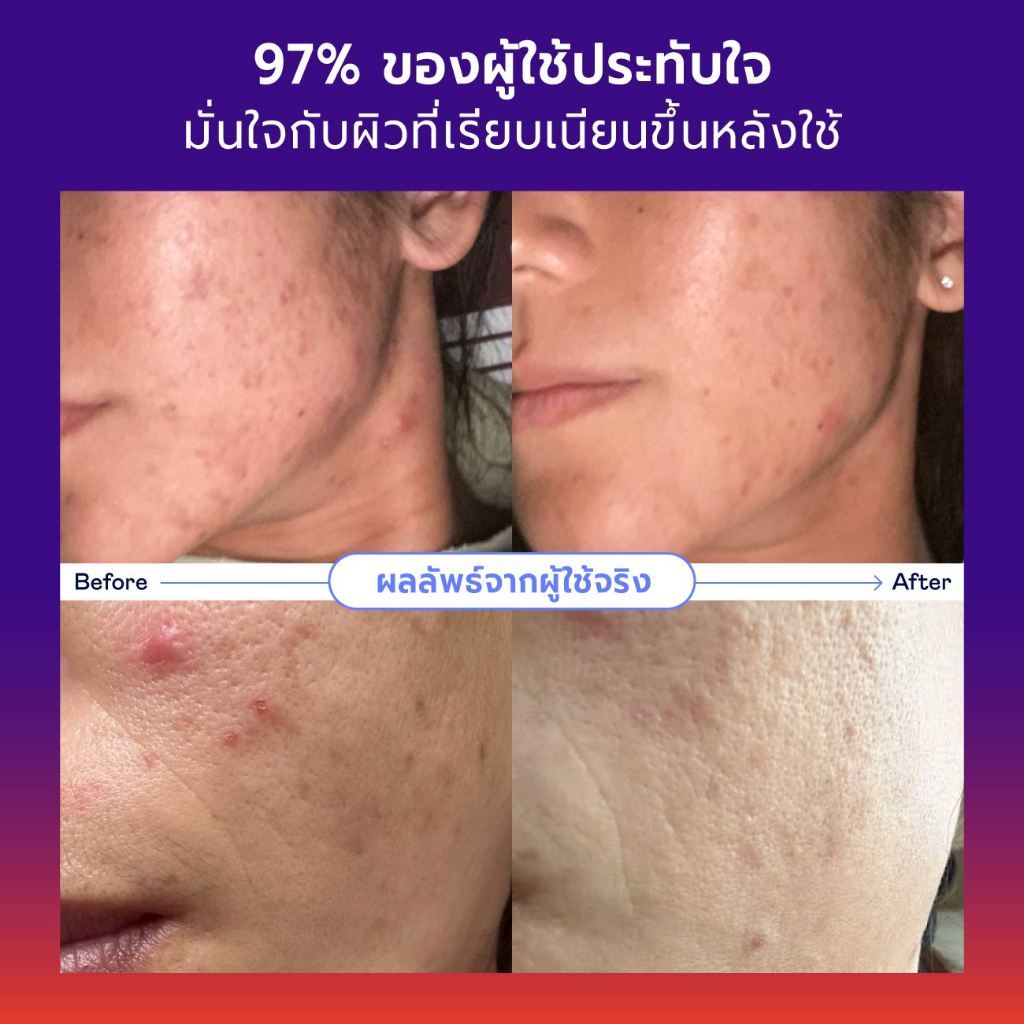 DIVYNE طقم ماسكات لحب الشباب والمسام — صورة 6