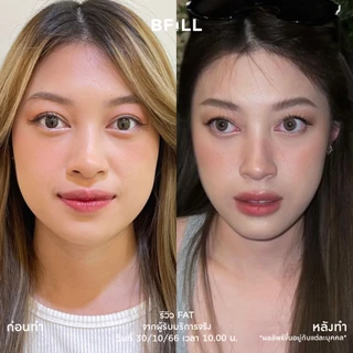 BFiLL โปรแกรม Fat ฉีดแฟต ลดไขมัน ลดแก้ม ลดเหนียง ปรับรูปหน้า หน้าเรียว กรอบหน้าชัด ลดสัดส่วน ลดไขมันเฉพาะจุด ผิวกระชับ