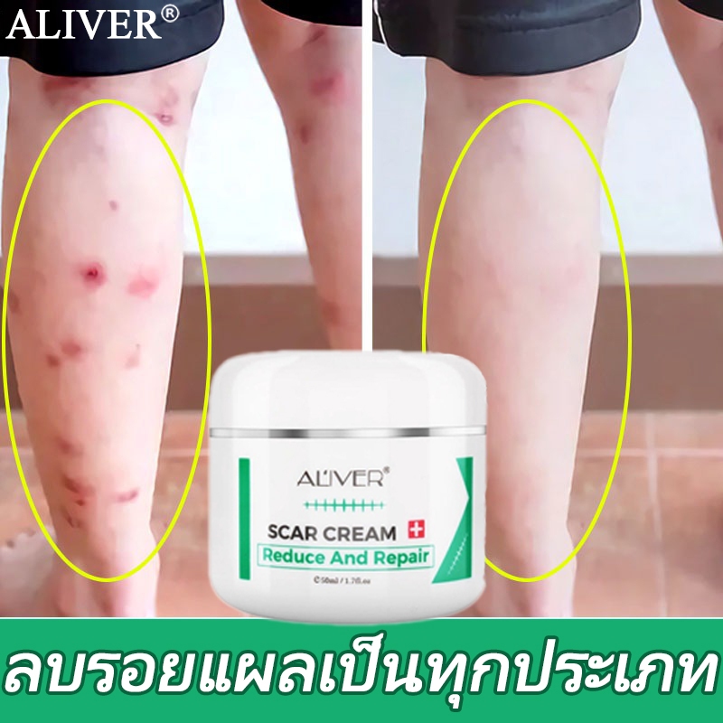 ALIVER ครีมลดรอยแผลเป็น 50ml ครีมทาแผลเป็น แผลไฟไหม้ รอยสิว รอยแตกลาย รอยแผลเป็นเป็นต้น ซ่อมแซมผิวหนัง ช่วยให้แผลเป็นหาย
