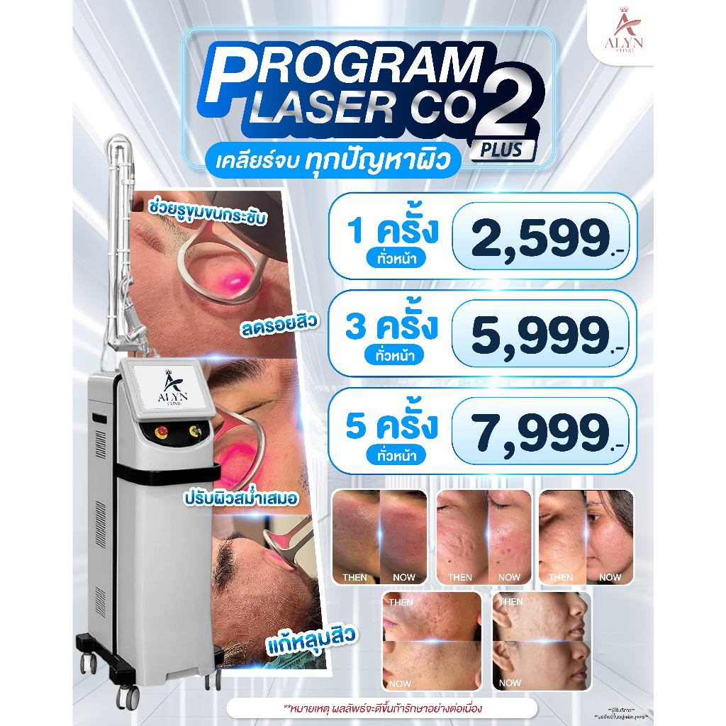 โปรแกรม Fractional CO2 Laser รักษาหลุมสิวและกระชับรูขุมขน