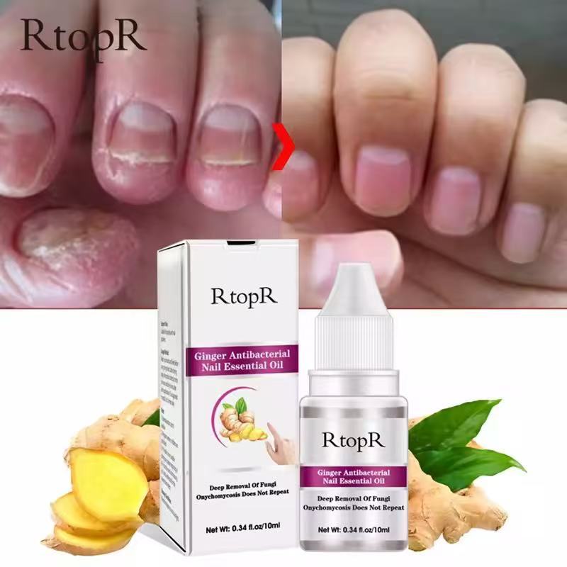 RtopR【FDA】 น้ำมันบำรุงเล็บสารสกัดขิง - เซรั่มบำรุงเล็บที่มีวิตามิน C และกรดไฮยาลูโรนิก ช่วยบำรุงเล็บให้เงางาม ดูแลขอบเล็