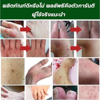 ครีมแก้คันผิว ลดผื่นคัน บรรเทาอาการคัน ฆ่าเชื้อรา ฟื้นฟูผิว เห็นผลไว 20G