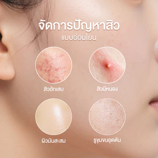 เจลล้างหน้า เจลโฟม สูตรสิว ล้างสะอาด ผิวไม่แห้ง Bye Bye Acne Gel-to-Foam Cleanser 140ml.