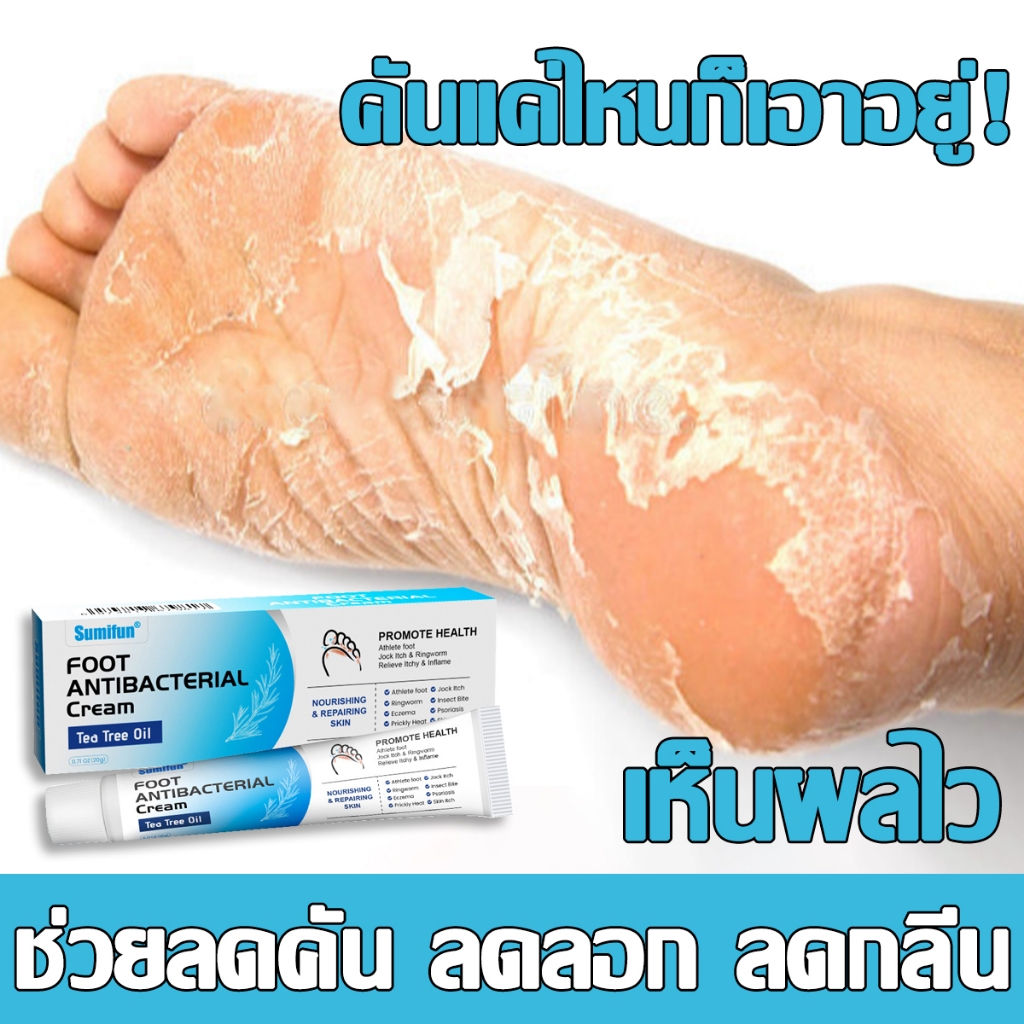 คันหายสบาย ครีมรักษาเชื้อราที่เท้า ครีมระงับกลิ่นเท้า บรรเทาคัน ป้องกันกลิ่น ฟื้นฟูผิวเท้า ครีมทาเท้า