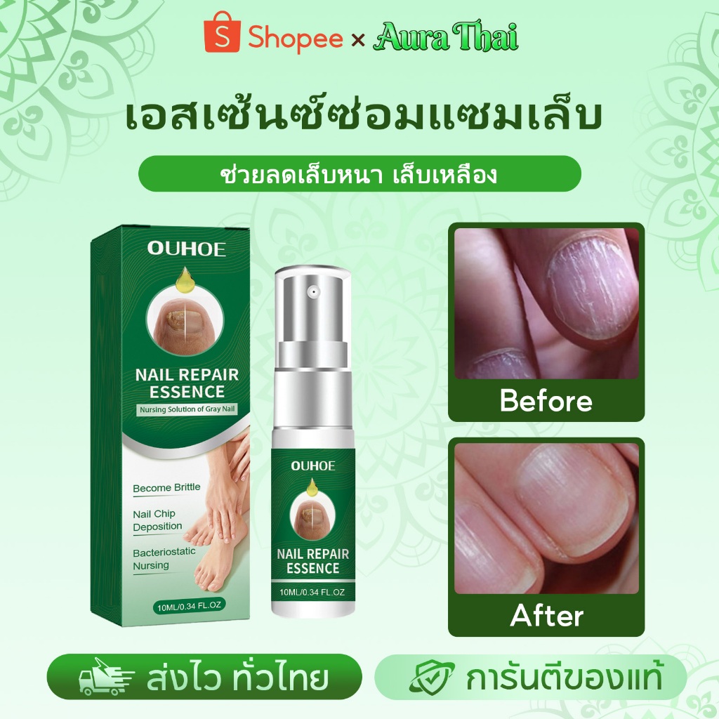 OUHOEน้ำยารักษาเชื้อราที่เล็บ เซรั่มบำรุงเล็บ สเปรย์บำรุงเล็บ สเปรย์บำรุงเล็บเท้า กำจัดเชื้อราที่เล็บ บำรุงเล็บเท้า ราคา ถูกที่สุด ดีลบีเคเค