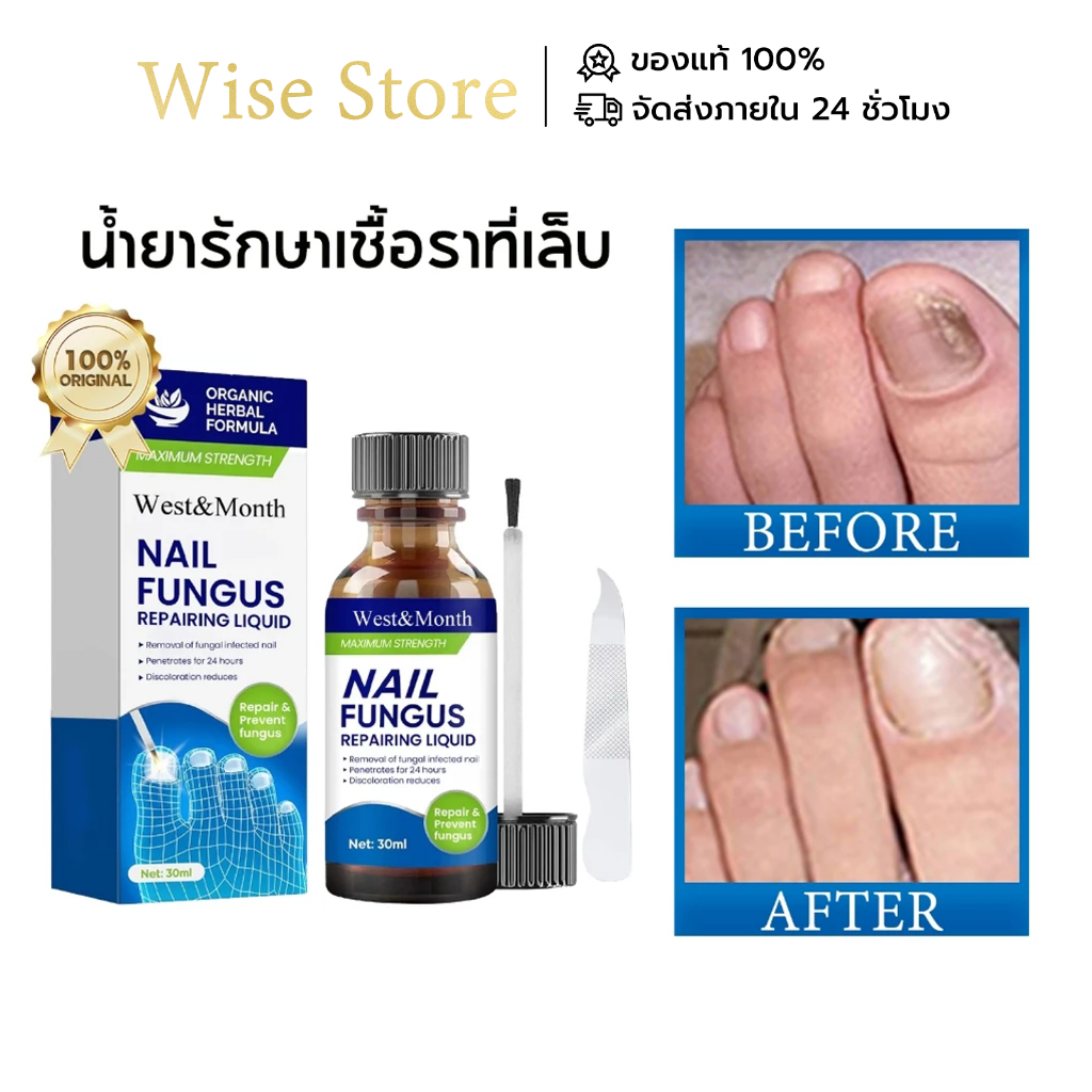 West&Month เล็บเชื้อรา น้ำยารักษาเชื้อราที่เล็บ น้ำยาซ่อมแซมเล็บเหลือง น้ำยารักษาเล็บ กำจัดเล็บเสีย Nail repair serum