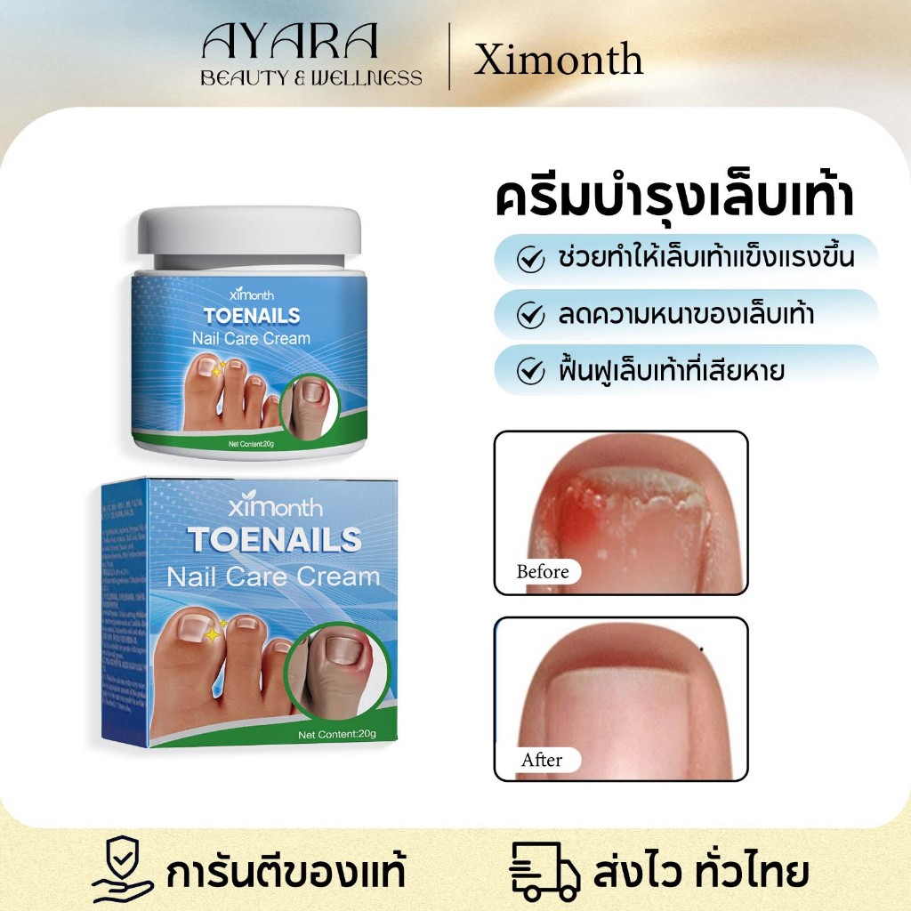 Ximonth ครีมรักษาโรคเชื้อราที่เล็บ ฆ่าเชื้อราที่เล็บ กำจัดเล็บเสีย ซ่อมแซมเล็บแต ฆ่าเชื้อรา เพื่อรักษาเชื้อรา บำรุงเล็บ