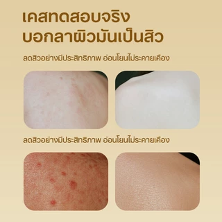 เจลอาบน้ำกำมะถัน ช่วยกำจัดไรขนาดเล็ก ลดสิวหลัง แผลอักเสบรูขุมขน ทำความสะอาดล้ำลึก เหมาะสำหรับผิวแพ้ง่าย ขนาด 500 มล