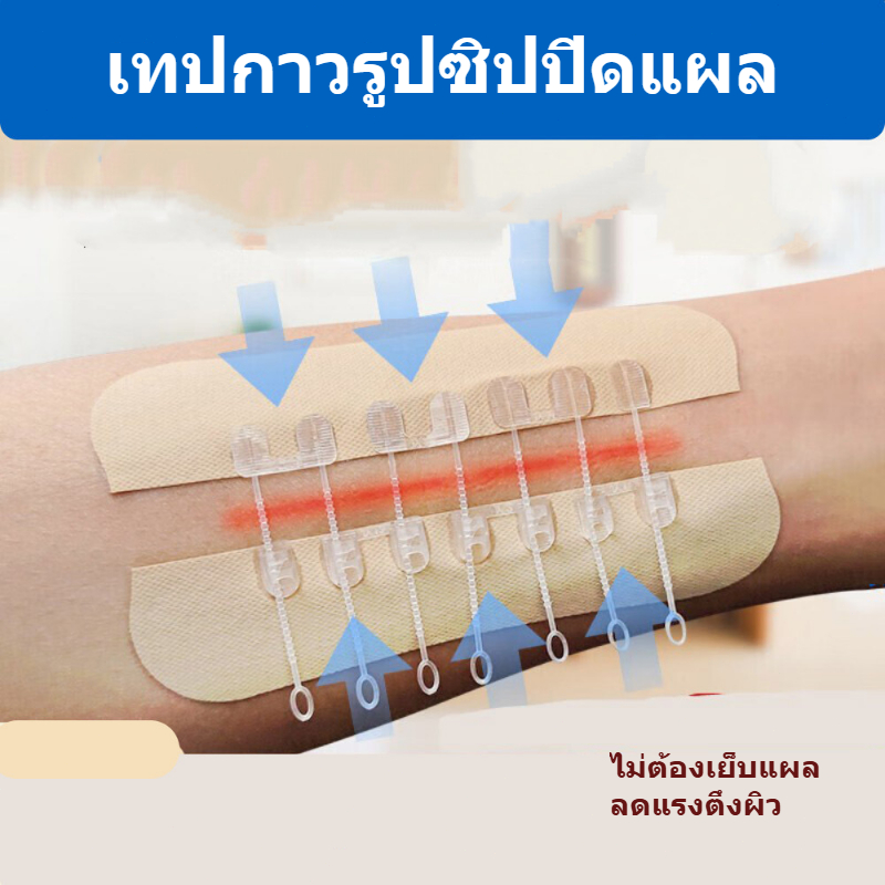 แผ่นปิดแผลแบบซิปไม่ต้องเย็บ ลดการดึงรั้งแผล ช่วยแผลหายเร็ว ผ้าพันแผลซิปลดแรงตึง