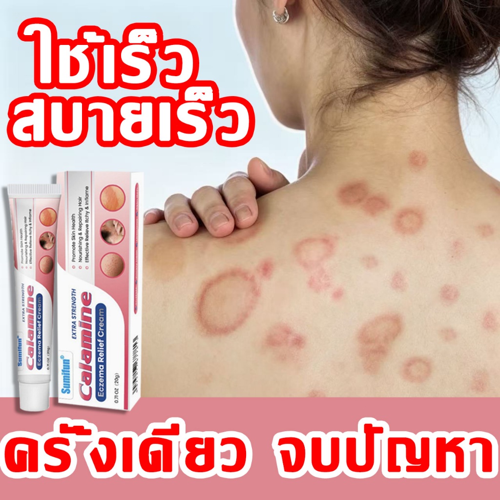 แค่ทา เห็นผล ครีมแก้เชื้อรา ดูแลเชื้อราผิวหนัง กลาก เกลื้อน ลดคัน ลดลอก บำรุงผิวแห้งกร้าน