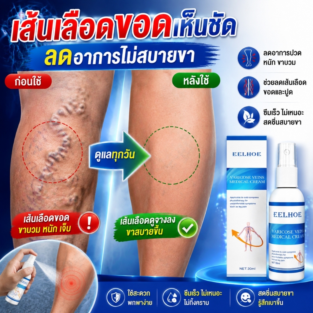 สเปรย์เส้นเลือดขอด ช่วยให้เส้นเลือดโป่งพองและเรียบเนียน นวดขา กำจัดเส้นเลือดขอด สเปรย์ดูแลขา ช่วยกระตุ้นการไหลเวียนโลหิต