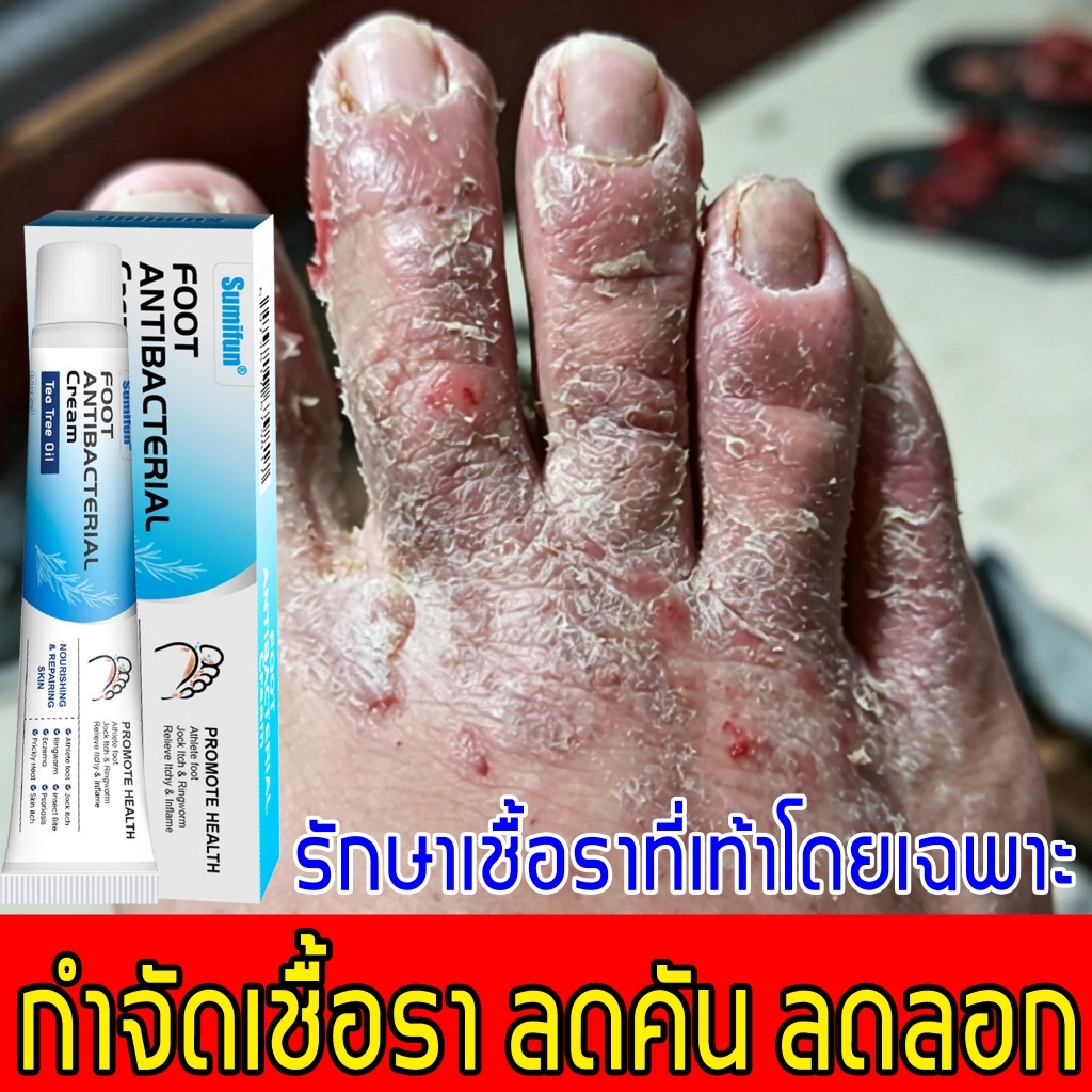 จัดส่งรวดเร็ว ครีมทาเท้า เท้าเหม็น คัน ลอก ตุ่มน้ำ สูตรธรรมชาติดูแลปัญหาเท้า ฆ่าเชื้อโรค บรรเทาอาการคัน ป้องกันกลิ่น