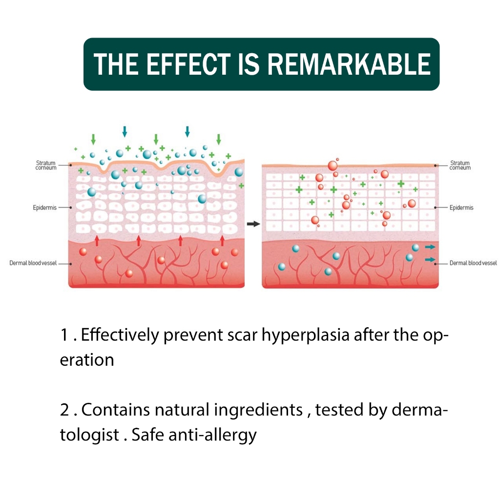 EELHOE แผ่นแผลเป็นซิลิโคน Silicone Scar Tape 4cm*150cm เทปซิลิโคนสำหรับรอยแผลเป็น, แผ่นซิลิโคนสำหรับรอยแผลเป็น - รูปที่ 4