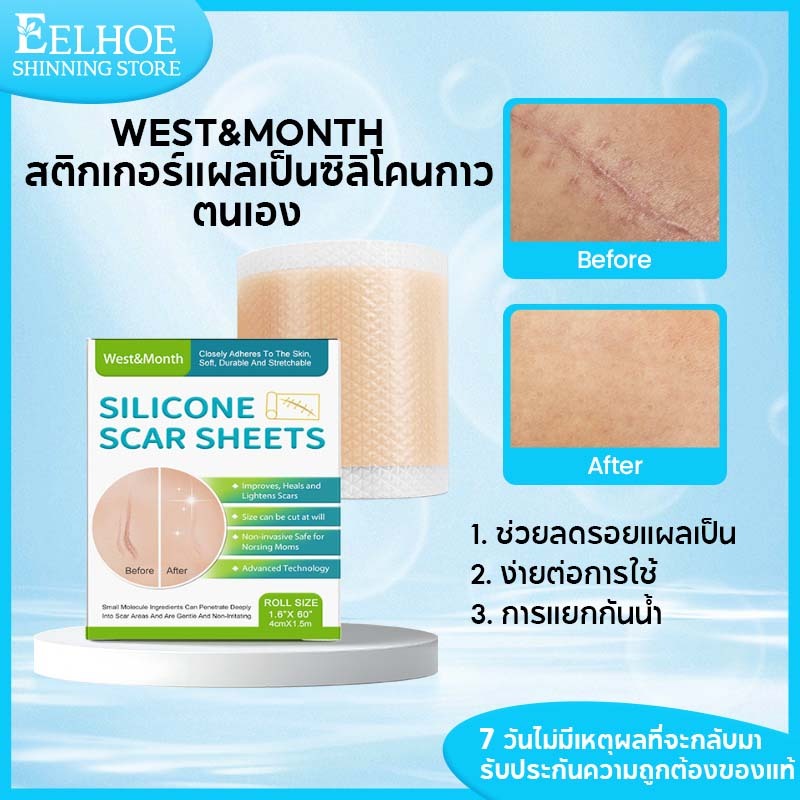 【1แถม1】West&Month แผ่นแปะแผลเป็น แผ่นแปะ ซิลิโคน ลดรอยแผลเป็น แผ่นซิลิโคนแปะแผลเป็นซิลิโคนแปะแผลเป็น