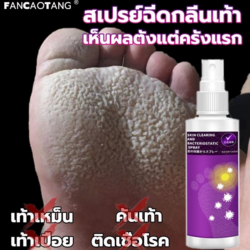 ถ้ารักษาไยไม่คิดเงิน☞ครีมลดเท้า ครีมทาเท้า ช่วยบรรเทาปัญหาเท้าลอกและมีกลิ่นได้อย่างรวดเร็ว ดับกลิ่นเท้าสเปย์ด