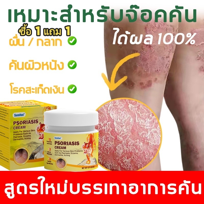 ซื้อ 1 แถม 1 ครีมลดอาการคัน 20g ทาแก้คัน ผิวหนังทากากเกลื้อน สารสกัดจากพืชใช้ได้ทั้งตัวบอกลาผิวคันได้ง่ายๆ
