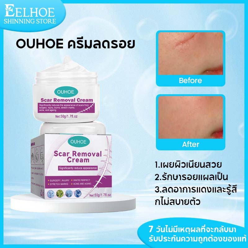 OUHOE ครีมลดรอย เจลลดรอยแผลเป็นครีมทาแผลเป็นรักษารอยแผลเป็นกําจัดรอยแผลเป็นจากแผลเป็นผิวนุ่มชุ่มชื้น