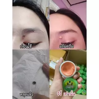 ครีมแต้มไฝ ครีมแต้มขี้แมลงวัน ครีมไฝ จีจี้ ไฝ หูด ตาปลา ติ่งเนื้อ ขี้แมลงวัน แต้มไฝ ครีมทาไฝ