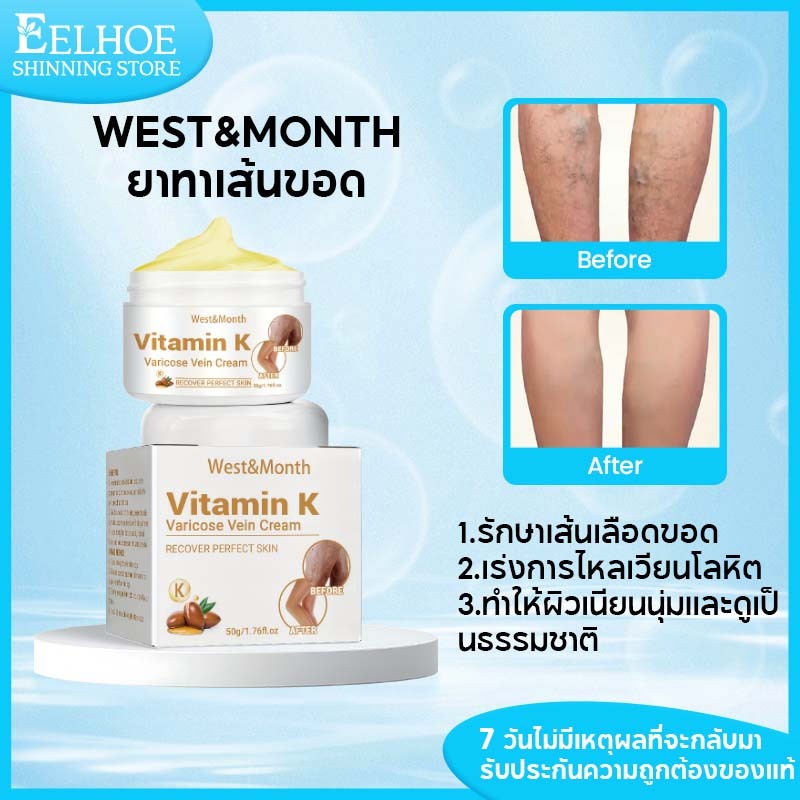 West&Month รักษาเส้นเลือดขอด ยาทาเส้นขอด ครีมนวดหลอดเลือดดํา ลดความรู้สึกไม่สบาย ผิวนุ่มชุ่มชื้น