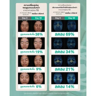 Moleculogy [Set 2 ชิ้น] AcneDecode Serum (50ml) + Starter Soft Cream (50g)