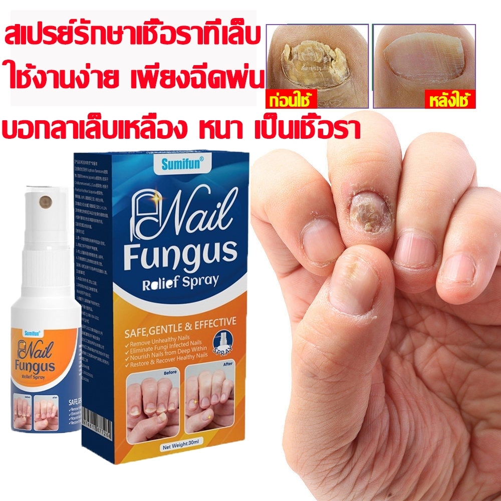 ดูแลเล็บสวยได้ง่ายๆ สเปรย์เล็บ ฟื้นฟูเล็บเสีย ลดการสะสมของเชื้อรา สเปรย์เดียวจบ!