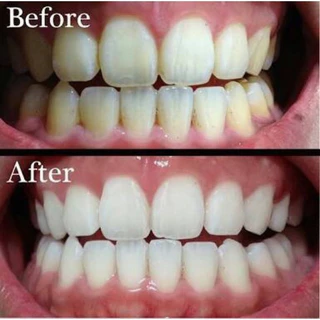 🦷ฟันขาวใส🦷 แผ่นฟอกสีฟัน แผ่นแปะฟันขาว ช่วยลดคราบเหลือง ให้ฟันดูขาวใส ใช้ง่าย พกพาสะดวก