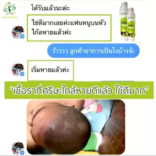 แชมพูอัลตร้ามายด์ แก้คัน รังแค เชื้อราหนังศีรษะ สเก็ตเงิน บำรุงผมให้ดกดำ