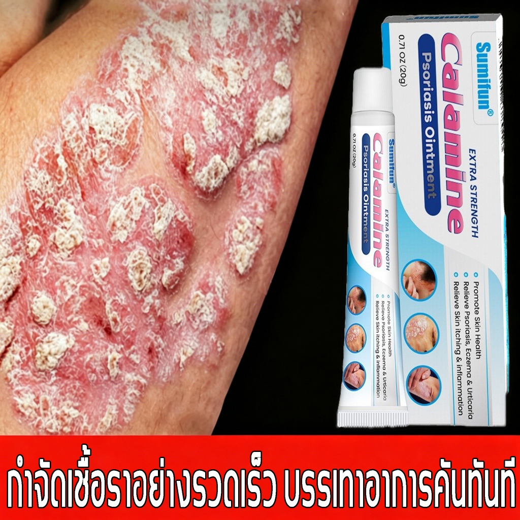 ครีมแก้คัน อ่อนโยน สารสกัดจากสมุนไพร ใช้ได้ทั่วร่างกาย สำหรับสะเก็ดเงิน กลาก เกลื้อน โรคผิวหนัง ลดอาการคัน บำรุงผิว