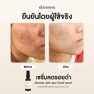 [พร้อมส่งทุกวัน] skinness dark spot facial serum | เซรั่มหน้าลดรอยดำ สำหรับผิวหน้า