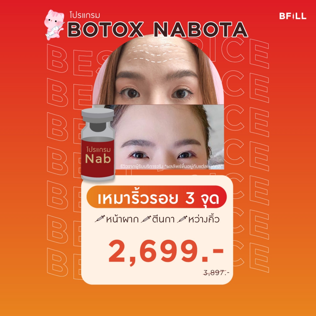 โปรแกรม Botox (Nabota) Wrinkles or Jawline or Face Lift / ริ้วรอย หรือ กราม หรือ ลิฟหน้า