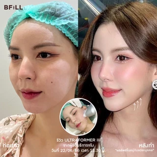 BFiLL โปรแกรม Ultraformer ยกกระชับลึกถึงชั้น SMAS, เก็บเหนียง by Doctor ไม่รวมยาชา Free Therma Lift บีฟิล คลินิก
