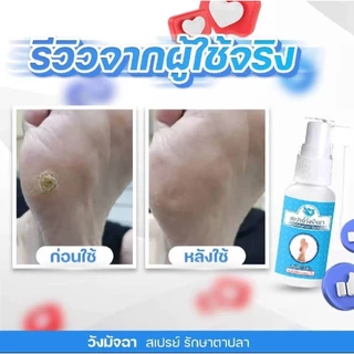 สเปรย์วังมัจฉา กำจัดตาปลาบนผิวหนัง หูดใต้ฝ่าเท้า ขนาด 20 มล.