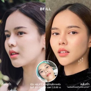 BFiLL โปรแกรม Hi Lift ไฮลิฟท์ by Specialist ลดแก้มป่อง, กรอบหน้าชัด บีฟิล คลินิก