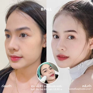 BFiLL โปรแกรม Hi Lift ไฮลิฟท์ by Specialist ลดแก้มป่อง, กรอบหน้าชัด บีฟิล คลินิก