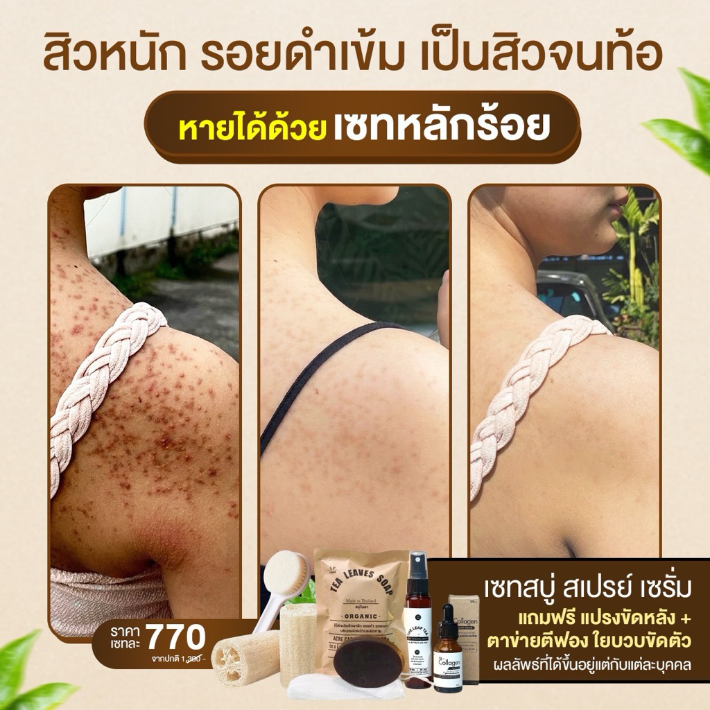 เซทรักษาสิวหลัง หน้า อก ไหล่ SET 6ชิ้นสุดคุ้ม สบู่+สเปรย์+เซรั่มใบชาสูตรแพทย์แผนไทย+ตาข่ายตีฟอง+ใยบวบ+แปรงขัดหลัง