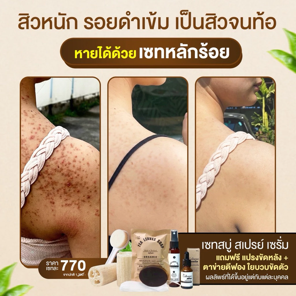 เซทรักษาสิวหลัง หน้า อก ไหล่ SET 6ชิ้นสุดคุ้ม สบู่+สเปรย์+เซรั่มใบชาสูตรแพทย์แผนไทย+ตาข่ายตีฟอง+ใยบวบ+แปรงขัดหลัง