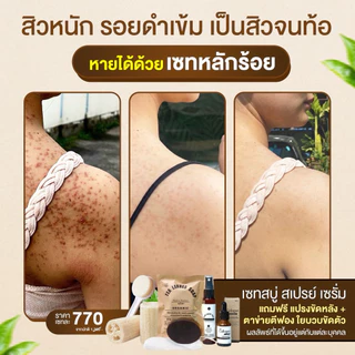 เซทรักษาสิวหลัง หน้า อก ไหล่ SET 6ชิ้นสุดคุ้ม สบู่+สเปรย์+เซรั่มใบชาสูตรแพทย์แผนไทย+ตาข่ายตีฟอง+ใยบวบ+แปรงขัดหลัง