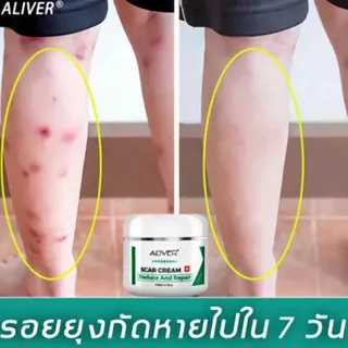 [ของแท้ 100%] ALIVER ครีมลดรอยแผลเป็น แผลเป็นนูนหนา แผลเป็นถลอก เร่งการซ่อมแซมให้ผิว ครีมแผลเป็น ลดแผลเป็น ยาทาแผลเป็น