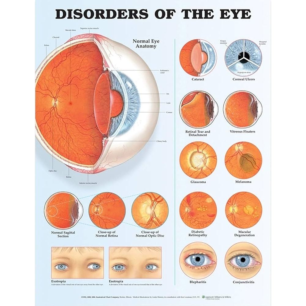 แผ่นโปสเตอร์ Disorders of the Eye Anatomical Chart (Paper) ed 2/2006 กรุณางดสั่งรวมกับหนังสือครับ