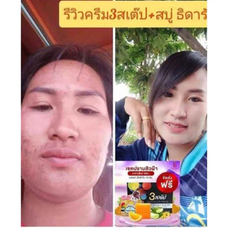 🍃✨ครีมรักษาสิว ฝ้า กระ #3สเต็ป ออร่าหน้าใส✨🍃